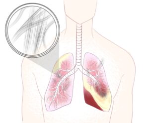 amianto nei polmoni